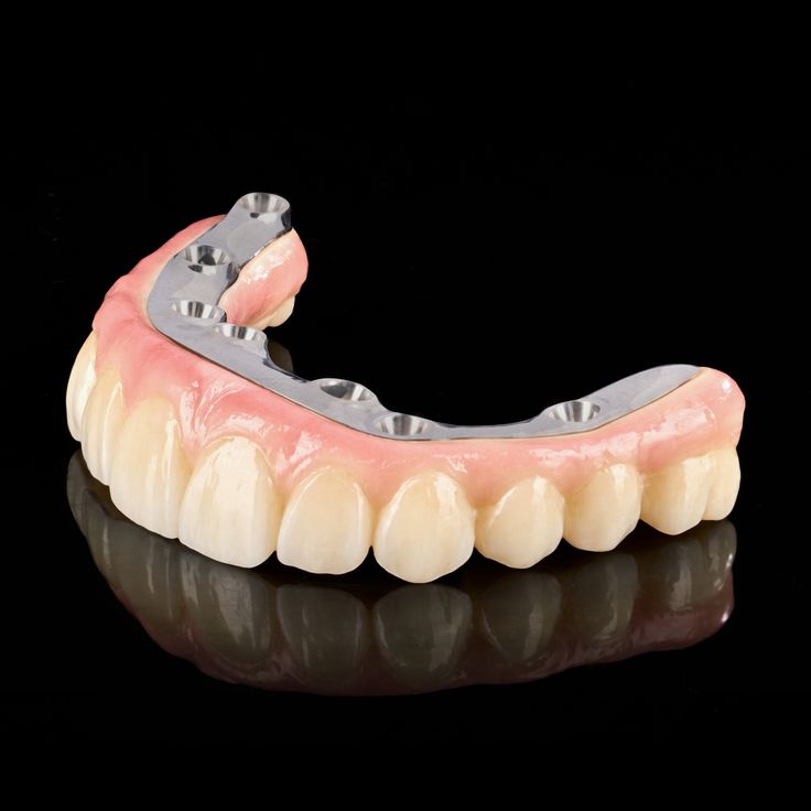 removable partial denture